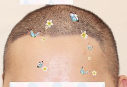 -大麦微针植发全国连锁