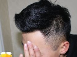 -大麦微针植发丨全国连锁