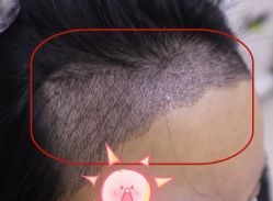 -大麦微针植发全国连锁