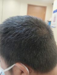 -碧莲盛·不剃发植发