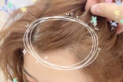 -大麦微针植发全国连锁