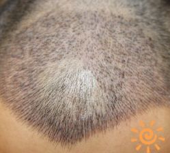 -大麦微针植发丨全国连锁