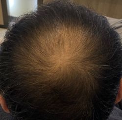 点击看大图 -大麦微针植发丨全国连锁