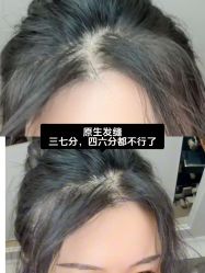 -碧莲盛·不剃发植发