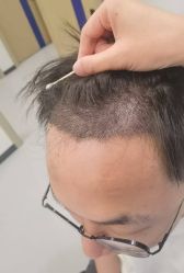 -大麦微针植发全国连锁