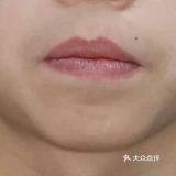 门牙外翻矫正案例