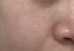 体验后-东莞缔美美容医院