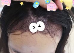 -大麦微针植发全国连锁