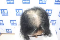 -大麦微针植发丨全国连锁
