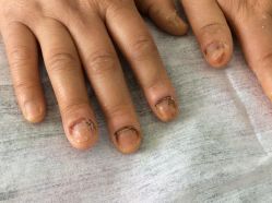 -德哥灰指甲脚气甲沟炎跖疣护理
