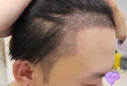 -大麦微针植发丨全国连锁