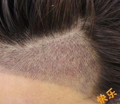 -大麦微针植发丨全国连锁