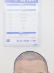 -大麦微针植发丨全国连锁