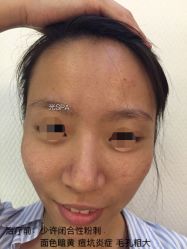 水光针-光SPA科技美肤