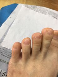 -EPAI·灰指甲·甲沟炎·嵌甲护理