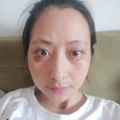-爱莎扁平疣·汗管瘤·斑痣中心