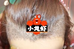 -大麦微针植发全国连锁