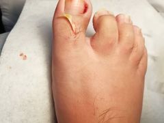 -世龙世家灰指甲鸡眼脚气甲沟炎跖疣护理(通州店)