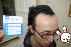 -大麦微针植发丨全国连锁