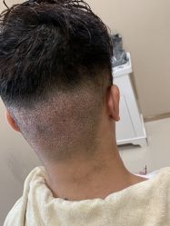 -大麦微针植发丨全国连锁