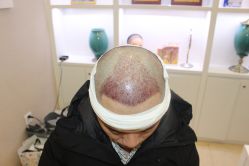 -大麦微针植发丨全国连锁