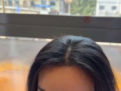 -碧莲盛·不剃发植发