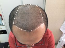 -大麦微针植发丨全国连锁