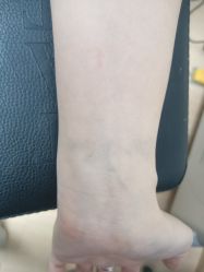 -天道专业洗纹身