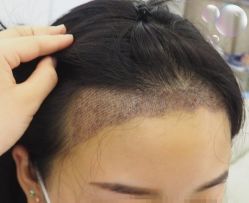 -大麦微针植发丨全国连锁