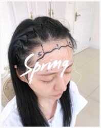 体验后-大麦微针植发全国连锁