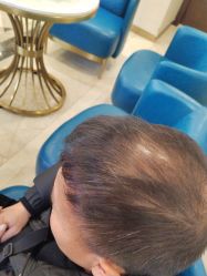 -碧莲盛·不剃发植发