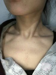 -美丽人生祛斑扁平疣汗管瘤中心