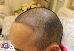 -大麦微针植发丨全国连锁