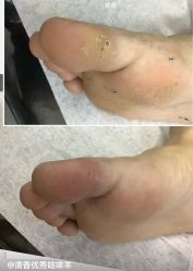 -德哥灰指甲脚气甲沟炎跖疣护理