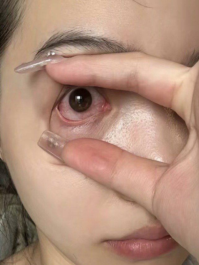 n长期佩戴隐形美瞳,
真的会带来一些不可逆的伤害!
