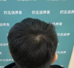 -碧莲盛·不剃发植发