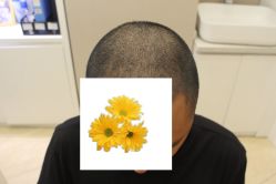 -大麦微针植发丨全国连锁