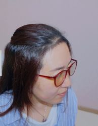 体验后-大麦微针植发全国连锁