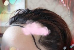 -大麦微针植发全国连锁