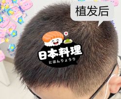 -大麦微针植发全国连锁