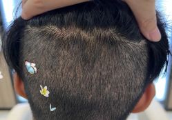 -大麦微针植发全国连锁