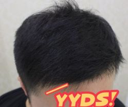 -大麦微针植发丨全国连锁