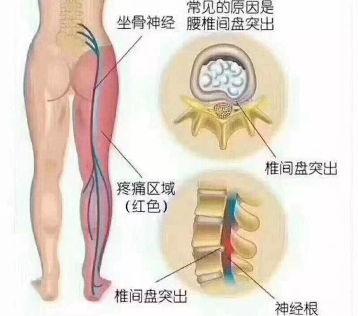 因为大多数的腰椎间盘突出都会压迫坐骨神经