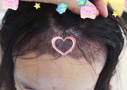 -大麦微针植发全国连锁