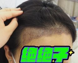 -大麦微针植发全国连锁