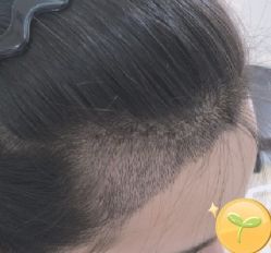 -大麦微针植发丨全国连锁