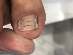 -Andrew指甲专科灰指甲·甲沟炎矫正·3D步态矫形鞋垫定制(浦三路店)