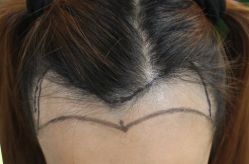 -大麦微针植发丨全国连锁