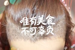 -大麦微针植发全国连锁