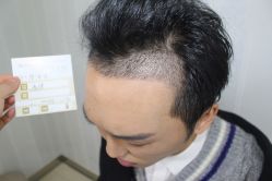 点击看大图 -大麦微针植发丨全国连锁